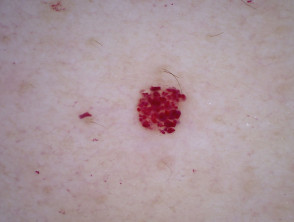 Cherry angioma dermoscopy