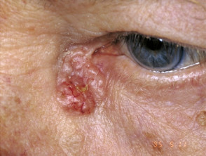 Basal cell carcinoma of medial canthus