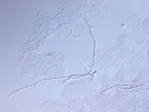 KOH microscopy of dermatophyte