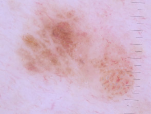 Melanoma in situ dermoscopy