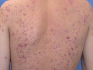 acne scar8 s