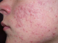 acne1 s