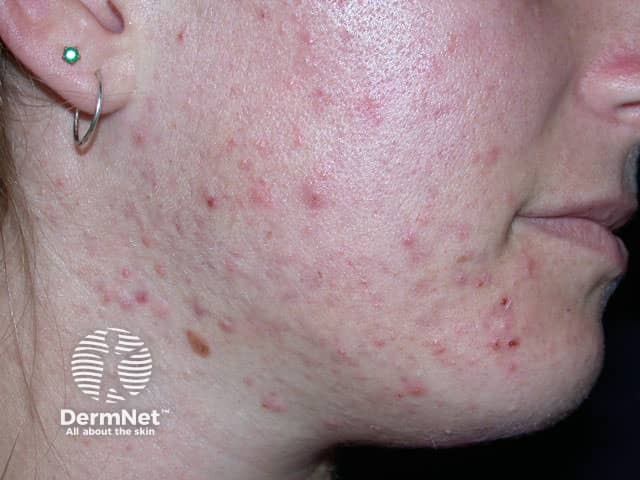 Acne vulgaris