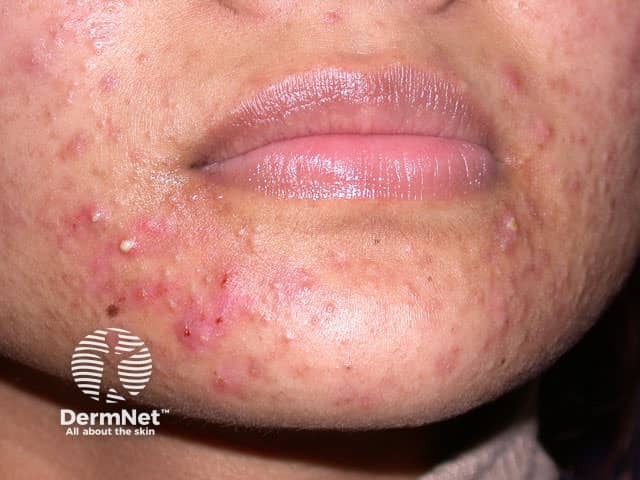 Acne vulgaris