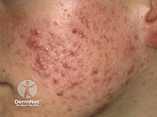 Acne vulgaris