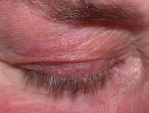 Steroid induced telangiectasia