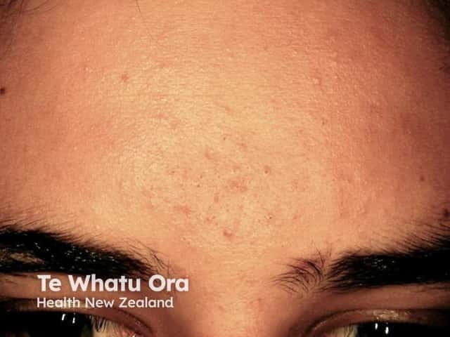 Mild acne vulgaris