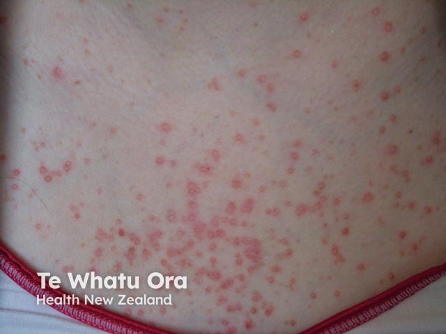Steroid acne