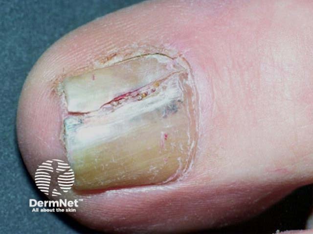 Melanoma of nail unit