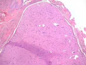 Angioleiomyoma histology
