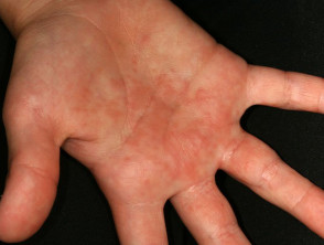 Hand irritation from contact with caterpillars
