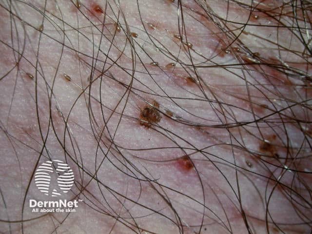 Natural Home Remedies For Pubic Lice Natural Home Remedies For Pubic Lice