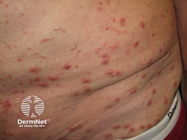 scabies symptoms pictures treatment more