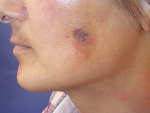 Postinflammatory hyperpigmentation  (inflamed cyst)