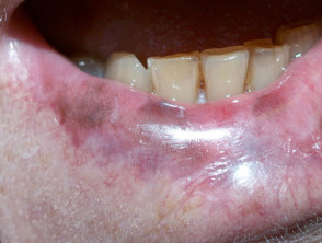 Pigmented contact cheilitis