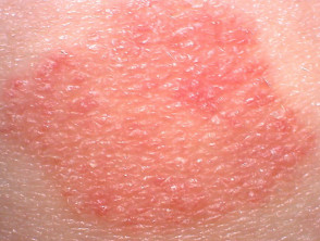 Red patch of psoriasis