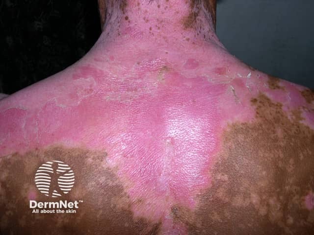 Sunburn in vitiligo