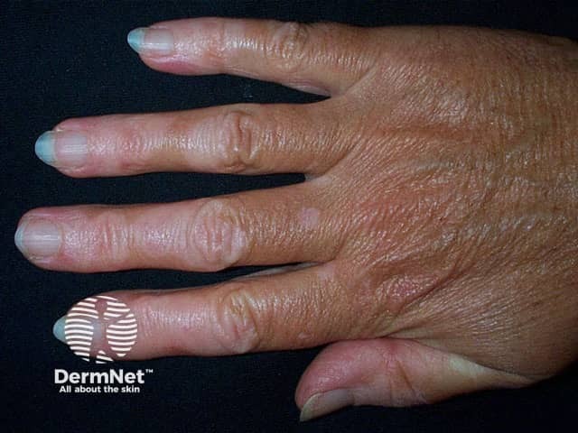Acral vitiligo