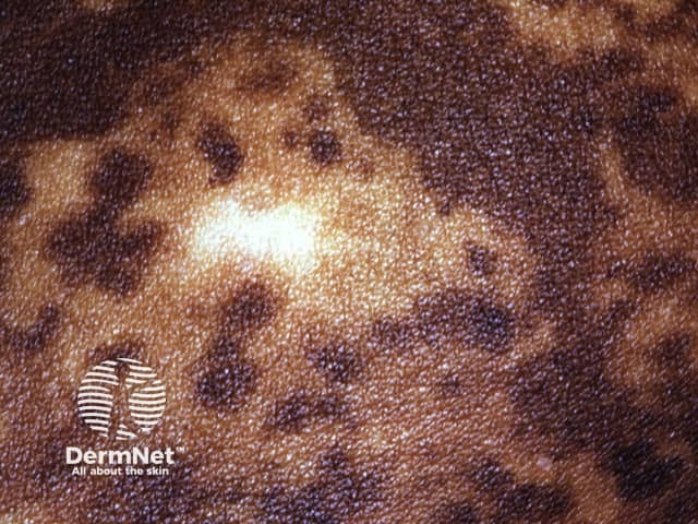 Trichrome vitiligo