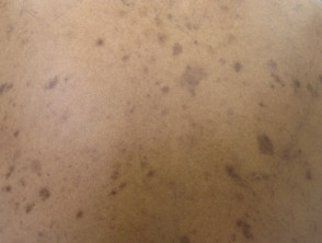 Postinflammatory pigmentation. Healed eczema