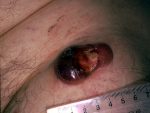 Cutaneous T cell lymphoma, tumour