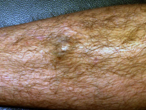 Osteoma cutis some years after haematoma due to blunt injury
