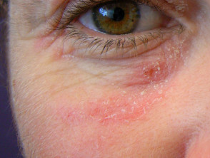 Contact allergic dermatitis under the eye