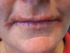 Contact allergic dermatitis on the lips