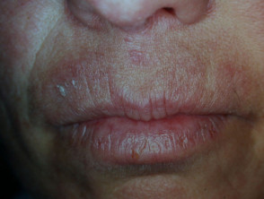 Contact allergic dermatitis around the lips