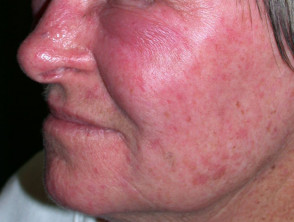 Contact allergic dermatitis