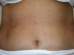 Contact allergic dermatitis of the torso 