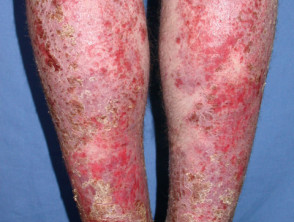 Infected dermatitis