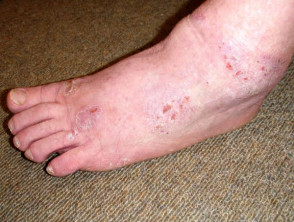 Contact dermatitis due to neoprene and diethylthiourea allergy