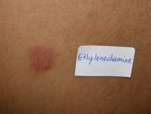 Contact dermatitis to ethylenediamine