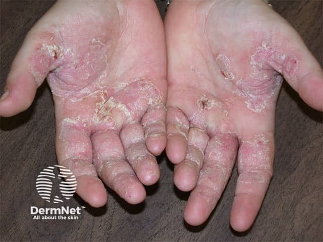 Hand dermatitis