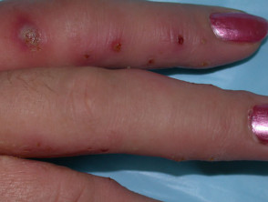 Infected vesicular hand dermatitis