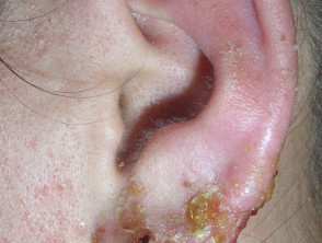 Infected earring reaction