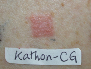 Positive patch test to isothiazolinone