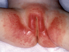 Napkin dermatitis