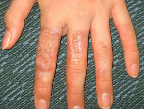 Photocontact dermatitis