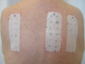 Baseline series of patch test allergens