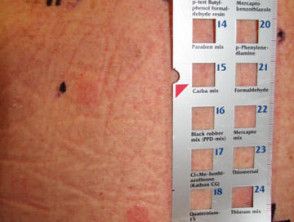 Baseline series of patch test allergens