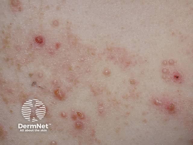 Molluscum contagiosum