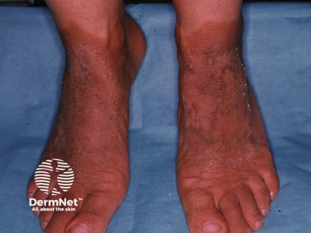 Pellagra