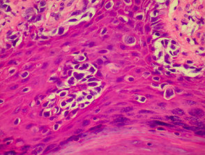 Pathology of pagetoid spread in melanoma 