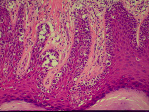 Pathology of acrolentiginous melanoma 