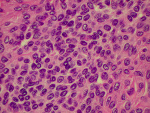 Pathology of deep naevus cells