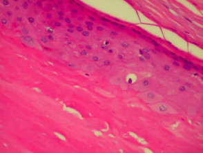 Pathology of pilar cyst