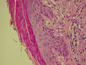 Pathology of actinic keratosis