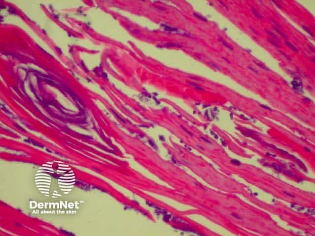 H&E stain of yeasts